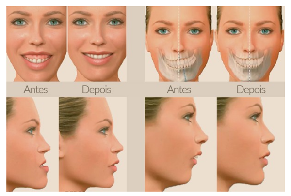 Cirurgia Ortognática - Comparativos Ilustrados