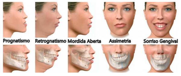 Cirurgia Ortognática - Tipos